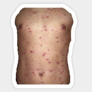 Chickenpox Sticker